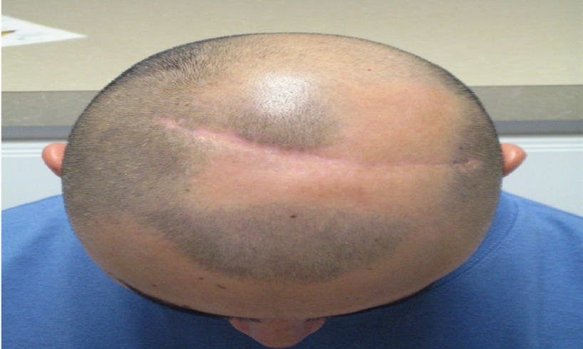 Dealing With Hair Loss